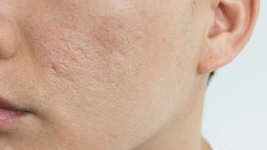 Do Acne Scar Go Away Naturally?