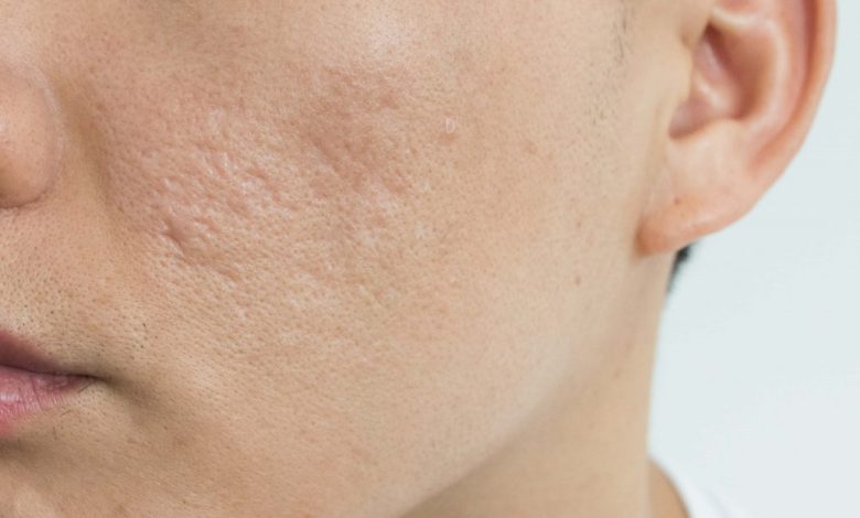 Do Acne Scar Go Away Naturally?