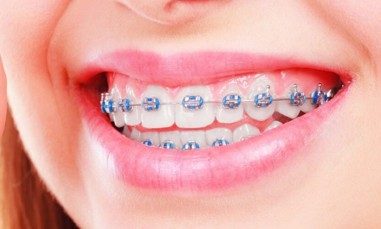 best braces colors