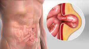 Hiatal Hernia treatment