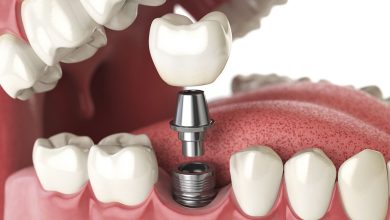 cheap dental implants houston