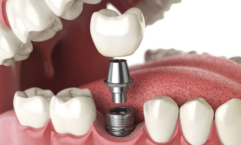 cheap dental implants houston