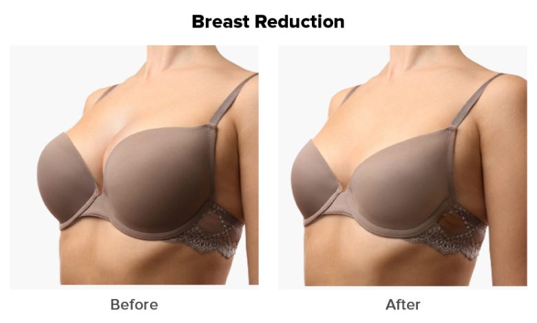 breast reduction surgeon near me