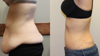 extended tummy tuck