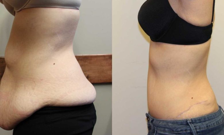 extended tummy tuck