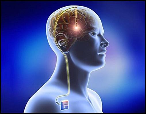 Neurostimulation Devices Market