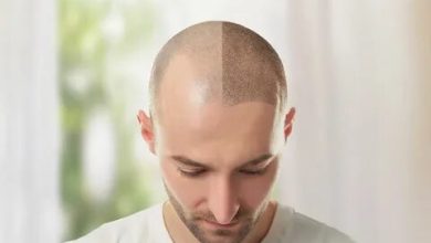 Hair Transplant