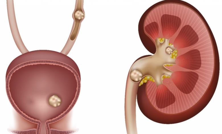 AYURVEDIC MANAGEMENT OF KIDNEY STONES