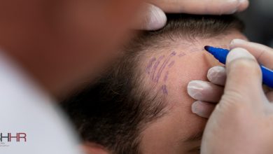 hair restoration palm desert