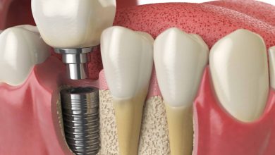 Tooth Extraction And Implant Timeline