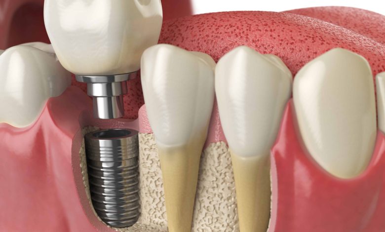 Tooth Extraction And Implant Timeline