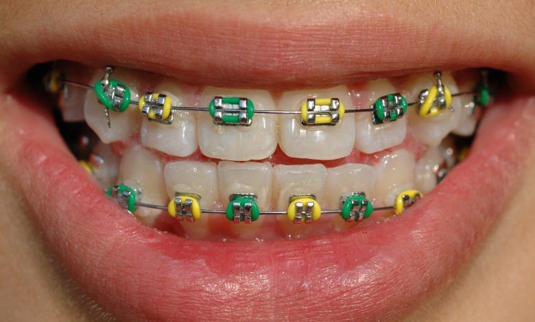 dark purple braces