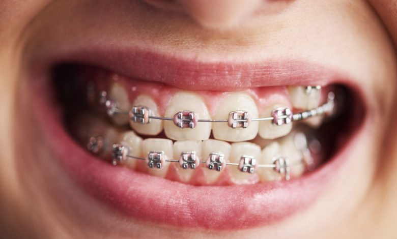 braces near me