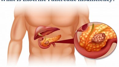 What Is Exocrine Pancreatic Insufficiency