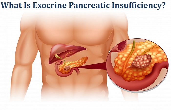 What Is Exocrine Pancreatic Insufficiency