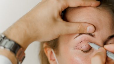 What do I need to know about Eyelid Surgery?