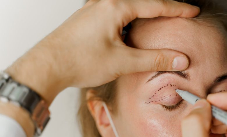 What do I need to know about Eyelid Surgery?