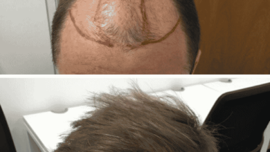 Best Hair Transplant in Dubai