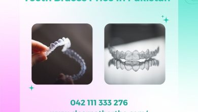 Teeth Braces Price in Pakistan