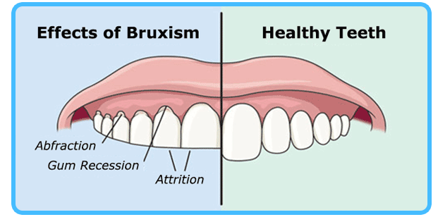 Botox-Injections-for-Bruxism-Botox-in-Dubai-Cost