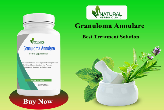 Herbal Treatment for Granuloma Annulare